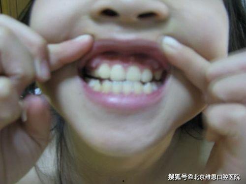 小孩长虎牙图片,虎牙萌娃的可爱瞬间